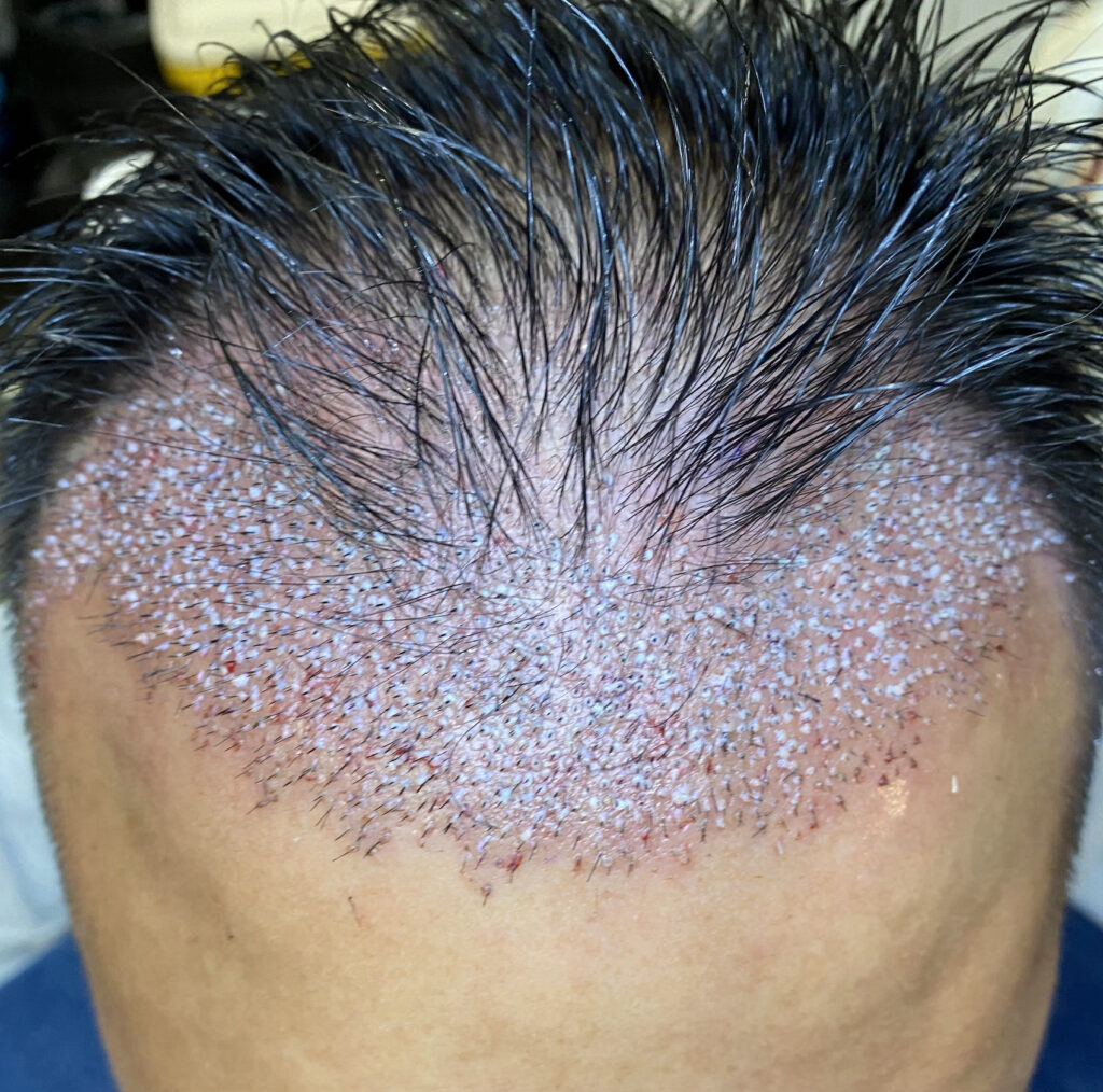 Hair Transplantation Dr Lisa Friederich